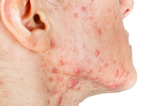 Acne Care and Allergy treatment in Houston Vital Allergy & Asthma