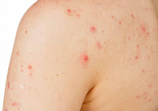 acne and skin allergy clinic in Houston