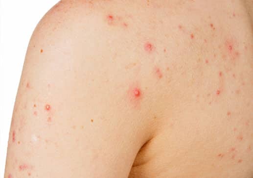 acne and skin allergy clinic in Houston 